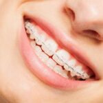 Why Invisalign is Better Than Braces - Read The Amazing Benefits Of Invisalign